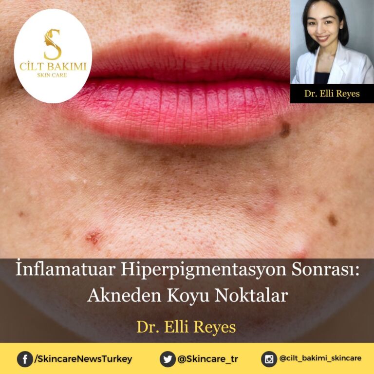 İnflamatuar Hiperpigmentasyon Sonrası: Akneden Koyu Noktalar