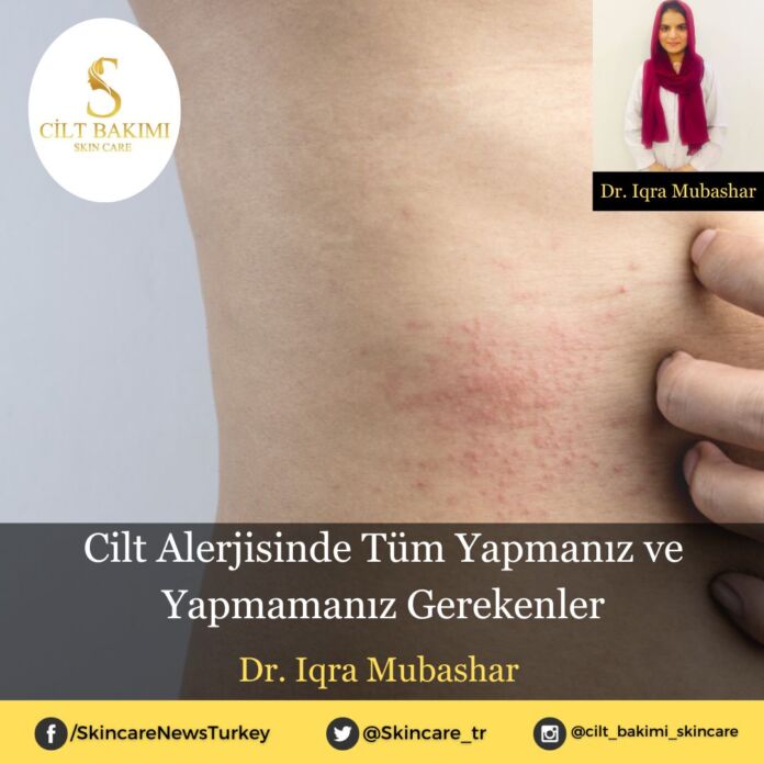 Cilt Alerjisinde Tüm Yapmanız ve Yapmamanız Gerekenler