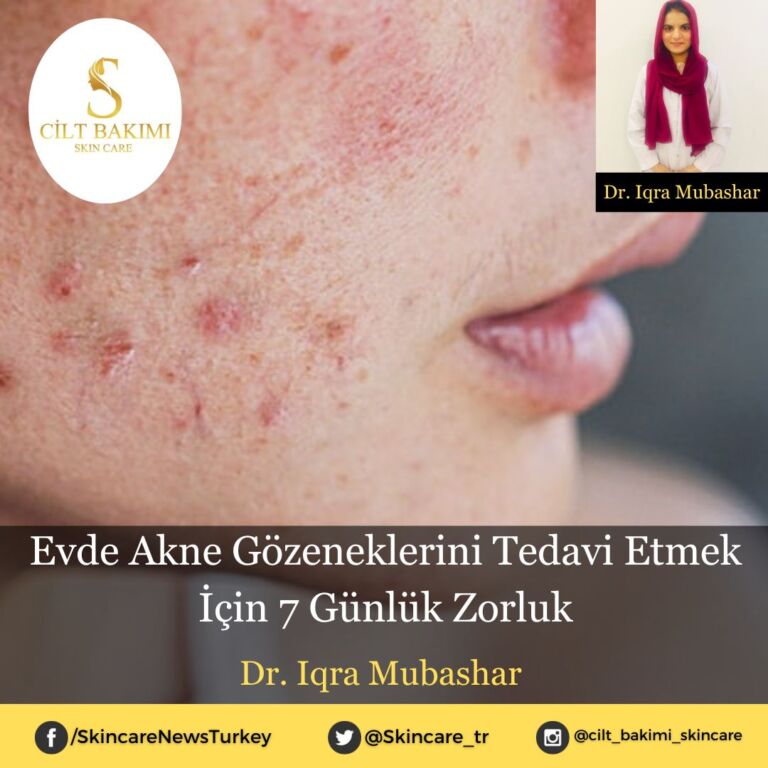 Evde Akne Gözeneklerini Tedavi Etmek İçin 7 Günlük Zorluk