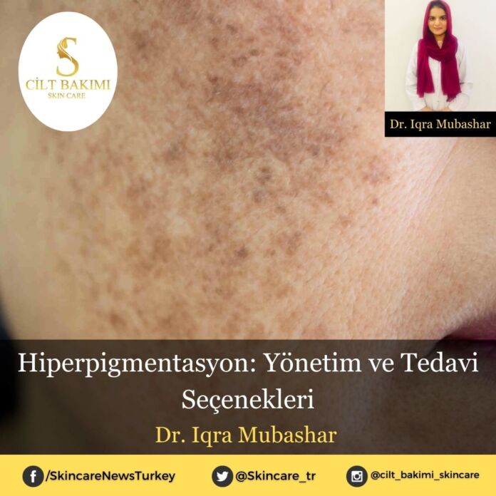 Skincare News v2 - Haziran Kopyası Hiperpigmentasyon: Yönetim ve Tedavi Seçenekleri
