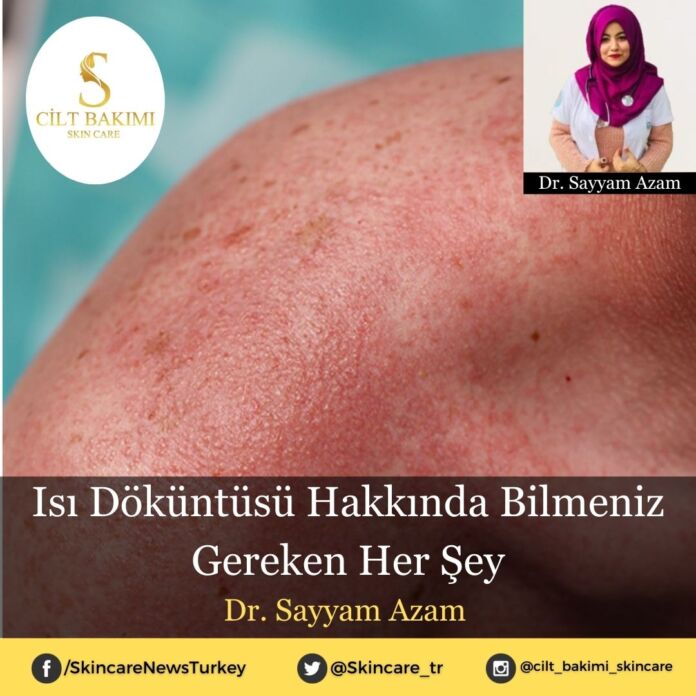 Isı Döküntüsü Hakkında Bilmeniz Gereken Her Şey