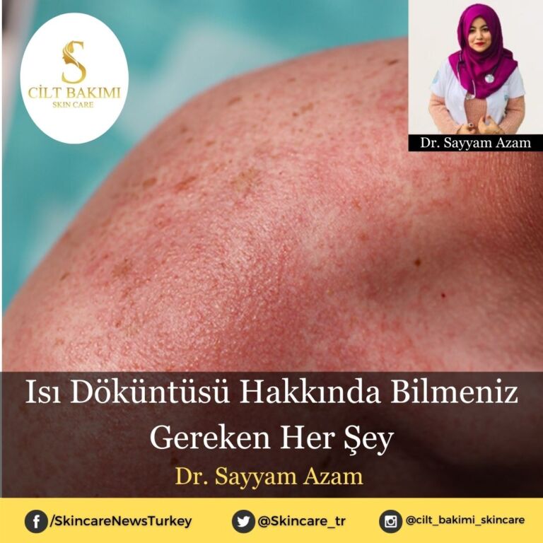 Isı Döküntüsü Hakkında Bilmeniz Gereken Her Şey