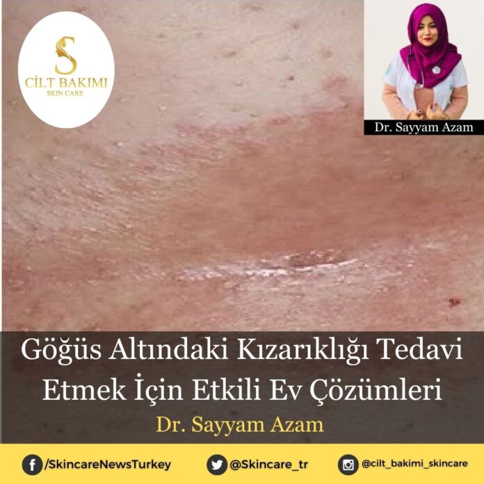 Skincare News v2 - Haziran Kopyası (5) Göğüs Altındaki Kızarıklığı Tedavi Etmek İçin Etkili Ev Çözümleri