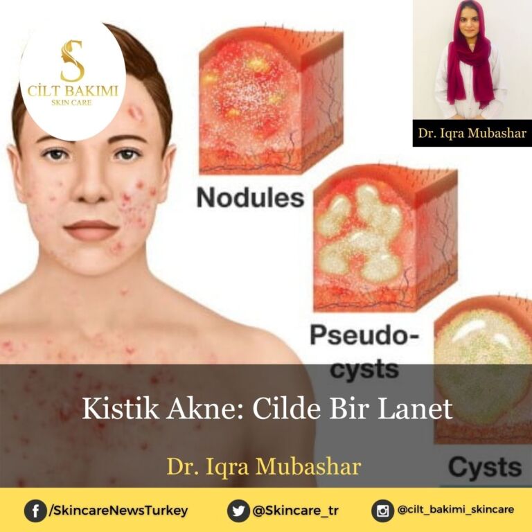 Kistik Akne: Cilde Bir Lanet