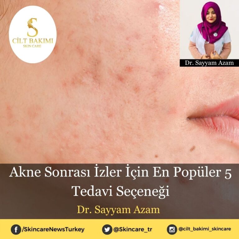 Akne Sonrası İzler İçin En Popüler 5 Tedavi Seçeneği