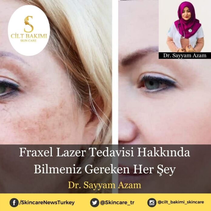 Skincare News v2 - Haziran Kopyası (7) Fraxel Lazer Tedavisi Hakkında Bilmeniz Gereken Her Şey
