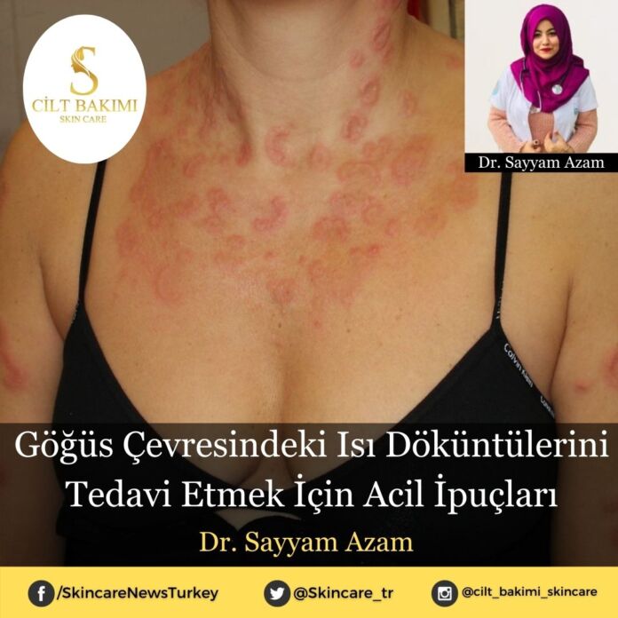 Göğüs Çevresindeki Isı Döküntülerini Tedavi Etmek İçin Acil İpuçları